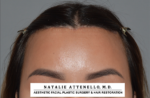 Hairline Lowering/Forehead Reduction