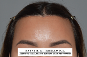 Hairline Lowering/Forehead Reduction Case 4178 After Photo Hairline Lowering/Forehead Reduction