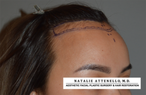 Hairline Lowering/Forehead Reduction Case 4178 Before Photo Hairline Lowering/Forehead Reduction
