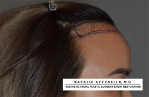 Hairline Lowering/Forehead Reduction Case 4178 Before Photo Hairline Lowering/Forehead Reduction