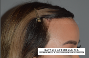 Hairline Lowering/Forehead Reduction Case 4178 After Photo Hairline Lowering/Forehead Reduction