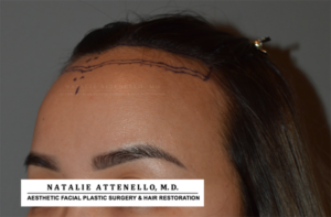 Hairline Lowering/Forehead Reduction Case 4178 Before Photo Hairline Lowering/Forehead Reduction