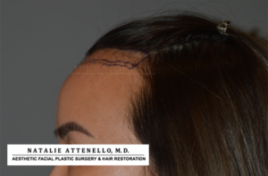 Hairline Lowering/Forehead Reduction Case 4178 Before Photo Hairline Lowering/Forehead Reduction