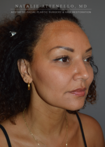 Patient before undergoing forehead reduction procedure by Dr. Attenello in Beverly Hills, CA