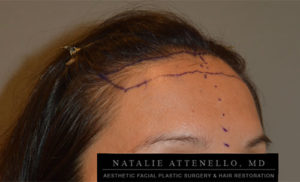 Hairline Lowering/Forehead Reduction Case 4286 Before Photo Hairline Lowering/Forehead Reduction
