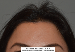 Hairline Lowering/Forehead Reduction Case 4265 After Photo Hairline Lowering/Forehead Reduction