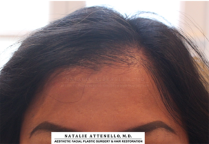 Hairline Lowering/Forehead Reduction Case 4265 Before Photo Hairline Lowering/Forehead Reduction
