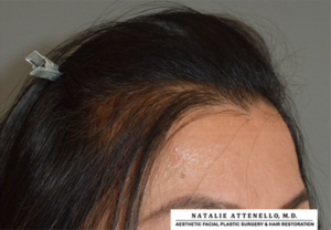 Hairline Lowering/Forehead Reduction Case 4265 Before Photo Hairline Lowering/Forehead Reduction