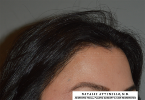 Hairline Lowering/Forehead Reduction Case 4265 After Photo Hairline Lowering/Forehead Reduction