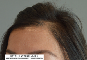 Hairline Lowering/Forehead Reduction Case 4265 Before Photo Hairline Lowering/Forehead Reduction