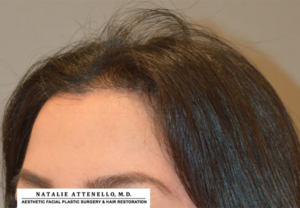 Hairline Lowering/Forehead Reduction Case 4265 After Photo Hairline Lowering/Forehead Reduction