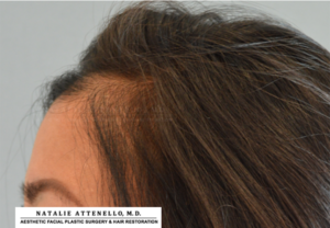 Hairline Lowering/Forehead Reduction Case 4265 Before Photo Hairline Lowering/Forehead Reduction