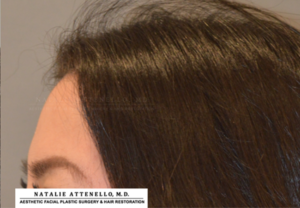 Hairline Lowering/Forehead Reduction Case 4265 After Photo Hairline Lowering/Forehead Reduction