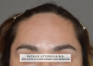 Close up view of patient's forehead before hairline lowering by Dr. Natalie Attenello in Beverly Hills