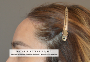 Side view of patient after undergoing hairline lowering/forehead reduction surgery by Dr. Natalie Attenello