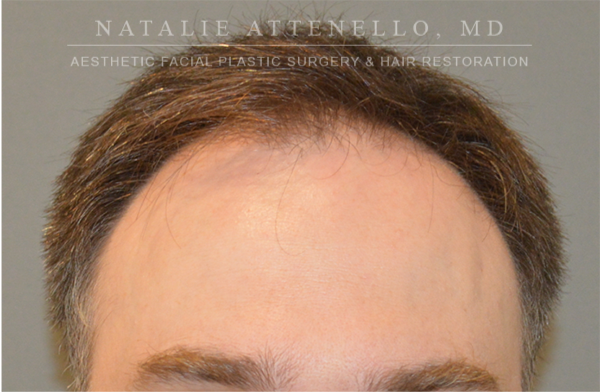 Hair Restoration