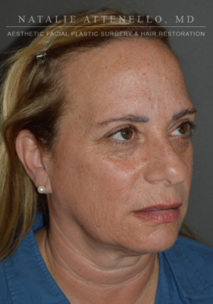 Facelift Case 4472 Before Photo Facelift