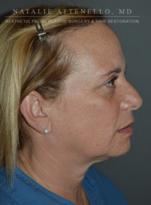 Facelift Case 4472 Before Photo Facelift
