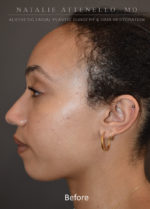 Hairline Lowering/Forehead Reduction