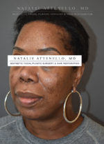 Hairline Lowering/Forehead Reduction