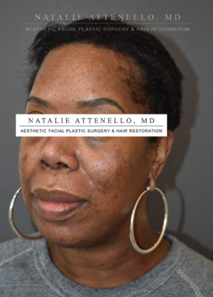 Hairline Lowering/Forehead Reduction Case 4502 After Photo Hairline Lowering/Forehead Reduction