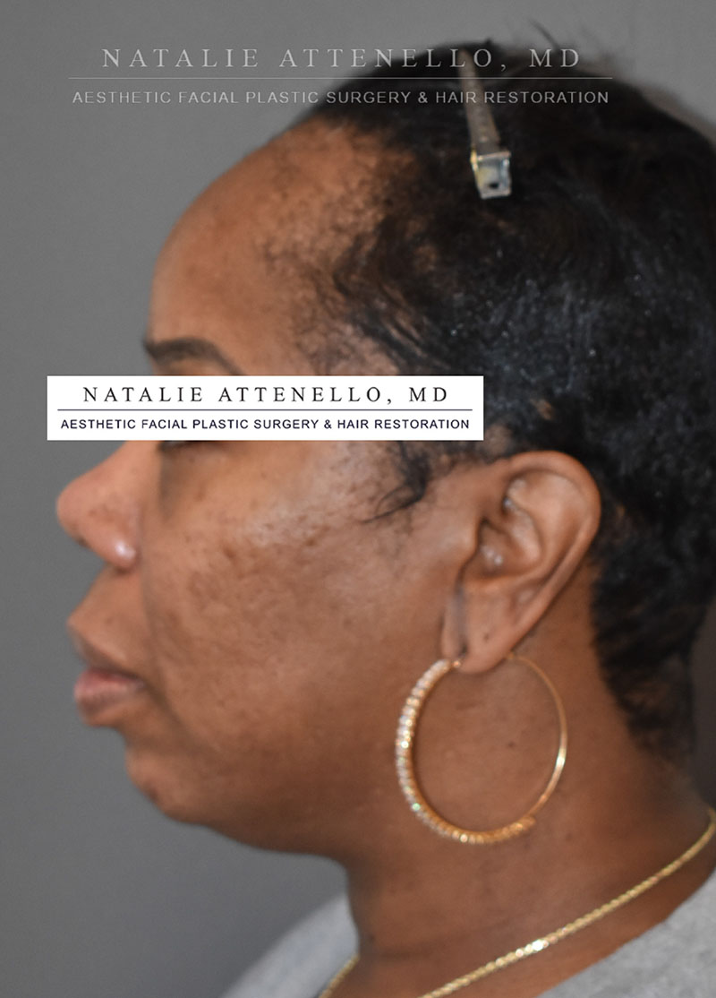 Hairline Lowering/Forehead Reduction