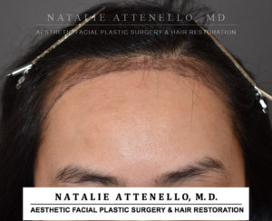 Hairline Lowering/Forehead Reduction Case 4503 Before Photo Hairline Lowering/Forehead Reduction