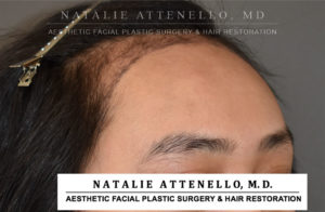 Hairline Lowering/Forehead Reduction Case 4503 Before Photo Hairline Lowering/Forehead Reduction