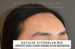 Hairline Lowering/Forehead Reduction