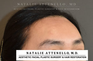 Hairline Lowering/Forehead Reduction Case 4503 After Photo Hairline Lowering/Forehead Reduction