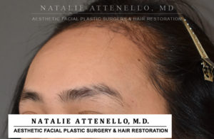 Hairline Lowering/Forehead Reduction Case 4503 Before Photo Hairline Lowering/Forehead Reduction