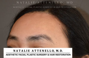 Hairline Lowering/Forehead Reduction Case 4503 After Photo Hairline Lowering/Forehead Reduction