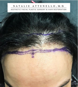 Hairline Lowering/Forehead Reduction Case 4722 Before Photo Hairline Lowering/Forehead Reduction