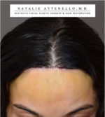 Hairline Lowering/Forehead Reduction
