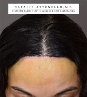 Hairline Lowering/Forehead Reduction Case 4722 After Photo Hairline Lowering/Forehead Reduction