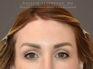 Hairline Lowering/Forehead Reduction