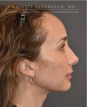 Hairline Lowering/Forehead Reduction Case 4741 Before Photo Hairline Lowering/Forehead Reduction