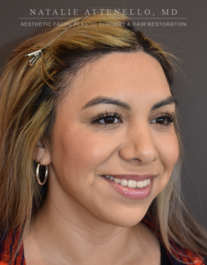 Hairline Lowering/Forehead Reduction