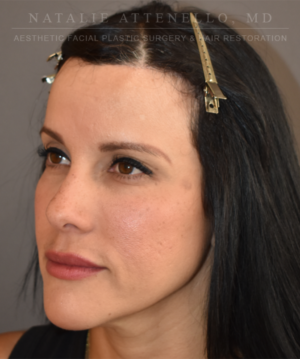 Hairline Lowering/Forehead Reduction Case 5178 After Photo Hairline Lowering/Forehead Reduction