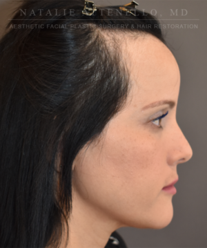 Hairline Lowering/Forehead Reduction Case 5178 Before Photo Hairline Lowering/Forehead Reduction