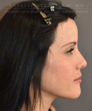 Hairline Lowering/Forehead Reduction Case 5178 After Photo Hairline Lowering/Forehead Reduction