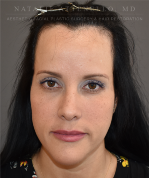 Hairline Lowering/Forehead Reduction Case 5178 Before Photo Hairline Lowering/Forehead Reduction
