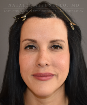 Hairline Lowering/Forehead Reduction Case 5178 After Photo Hairline Lowering/Forehead Reduction