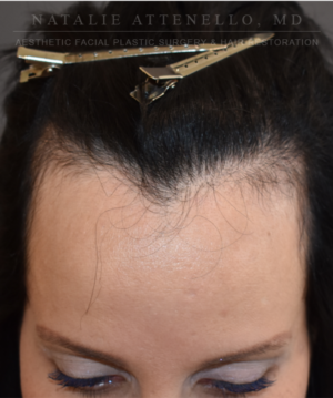 Hairline Lowering/Forehead Reduction Case 5178 Before Photo Hairline Lowering/Forehead Reduction