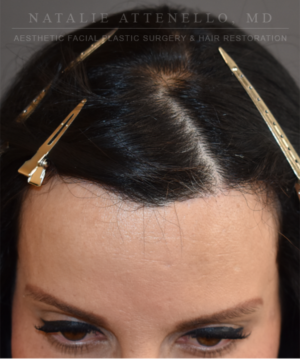 Hairline Lowering/Forehead Reduction Case 5178 After Photo Hairline Lowering/Forehead Reduction
