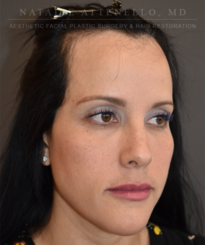 Hairline Lowering/Forehead Reduction Case 5178 Before Photo Hairline Lowering/Forehead Reduction