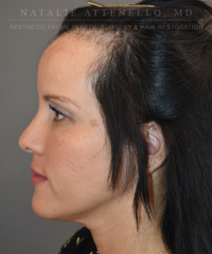 Hairline Lowering/Forehead Reduction Case 5178 Before Photo Hairline Lowering/Forehead Reduction