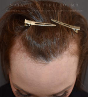 Hairline Lowering/Forehead Reduction Case 5177 Before Photo Hairline Lowering/Forehead Reduction