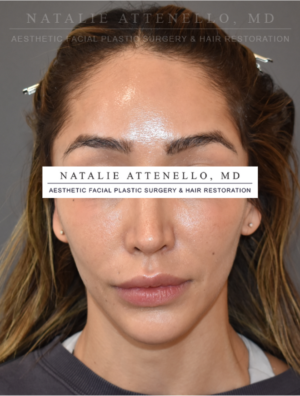 Hairline Lowering/Forehead Reduction Case 5179 Before Photo Hairline Lowering/Forehead Reduction