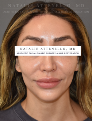 Hairline Lowering/Forehead Reduction Case 5179 After Photo Hairline Lowering/Forehead Reduction
